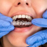 invisalign benefits