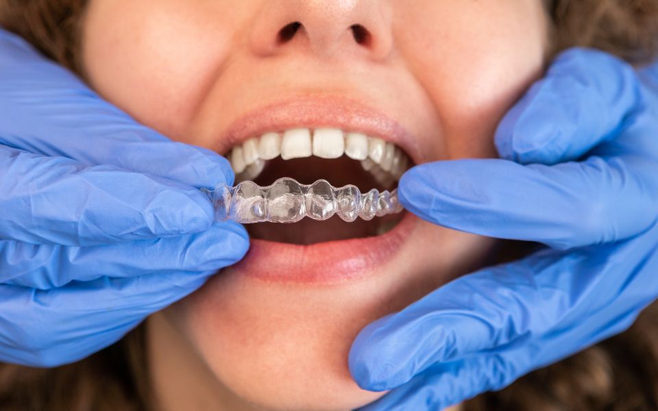 invisalign benefits