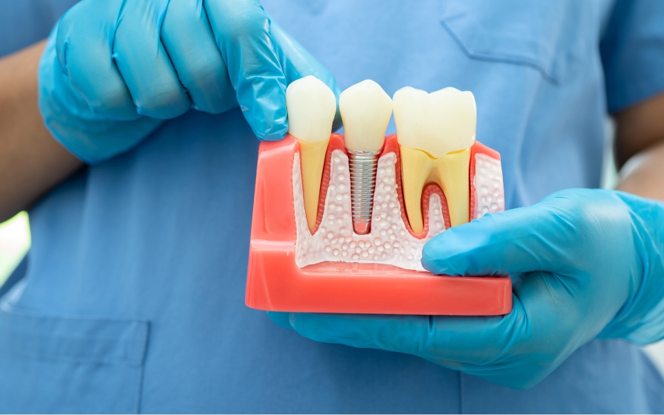 5 Common Fears About Dental Implants – And Why You Shouldn’t Worry