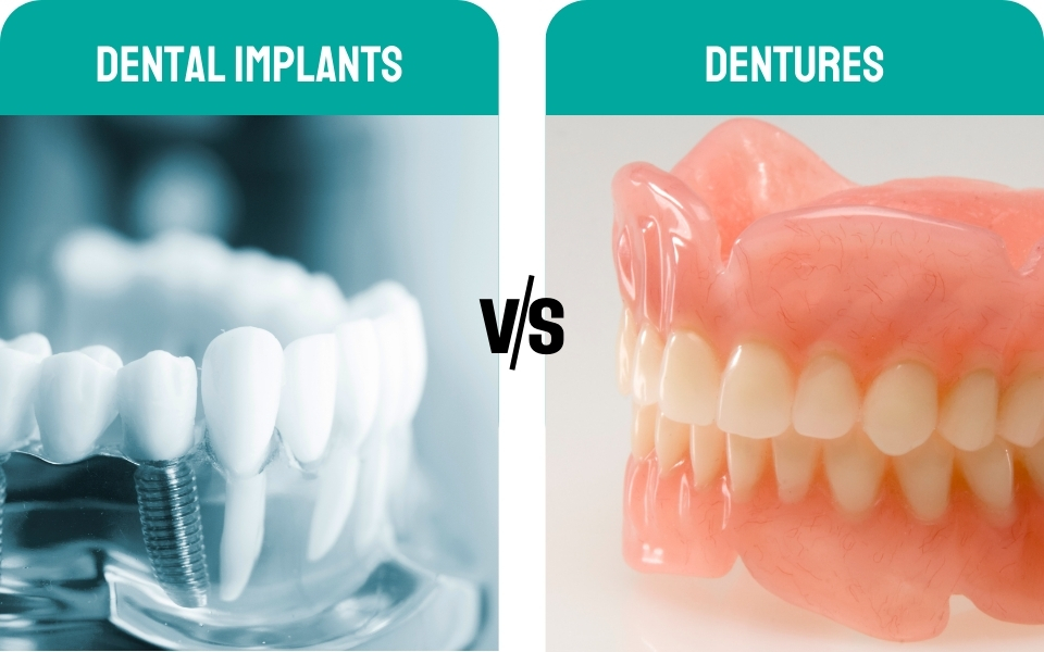 Dental Implants vs. Dentures: Making the Right Choice for Your Lifestyle