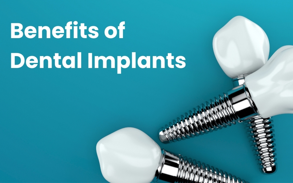 Hidden Benefits of Dental Implants That Nobody Talks About