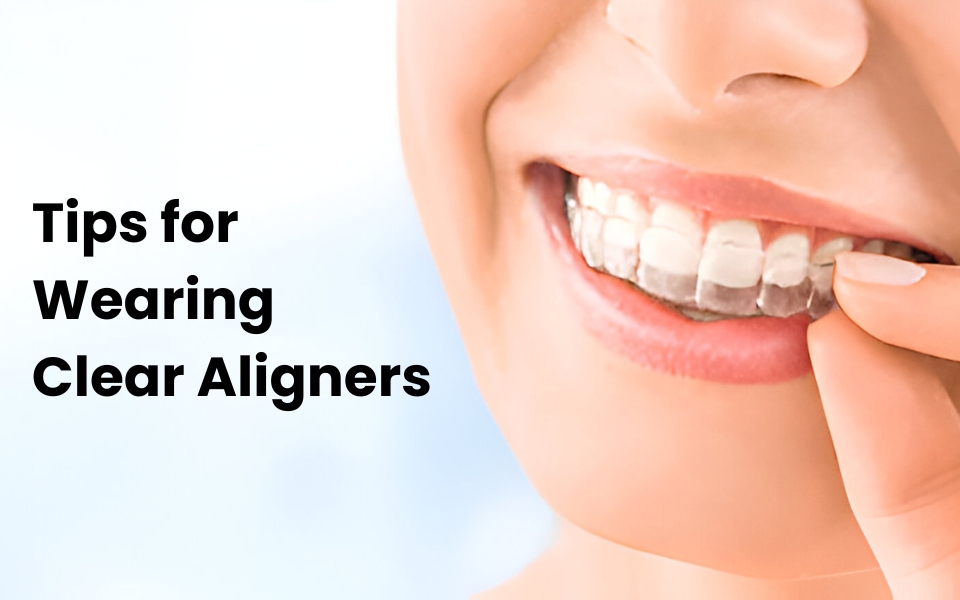 Essential Tips for Wearing Clear Aligners Successfully