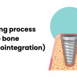 The Science Behind Osseointegration: Understanding How Dental Implants Fuse with Bone