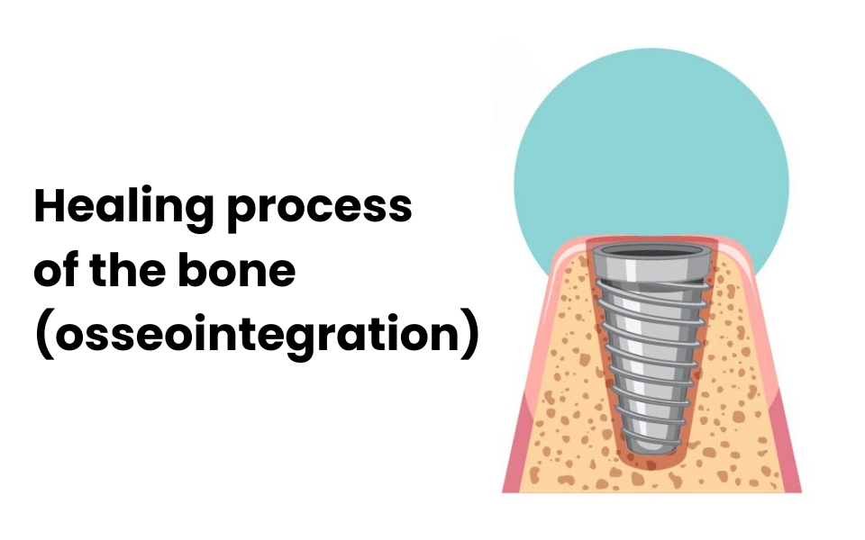 The Science Behind Osseointegration: Understanding How Dental Implants Fuse with Bone