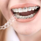 Invisalign vs. Traditional Braces