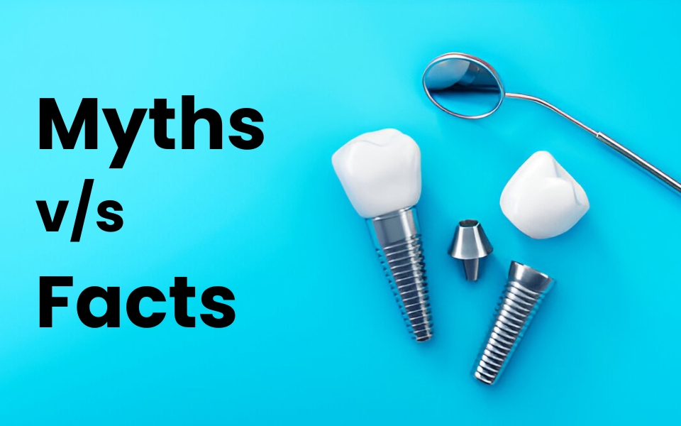 Myths vs. Facts: The Truth About Modern Dental Implants